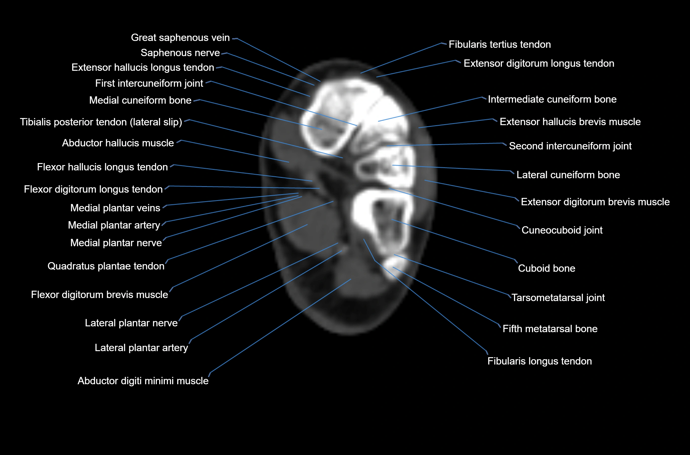 CT Ankle axial cross sectional anatomy labelled image -00053.webp